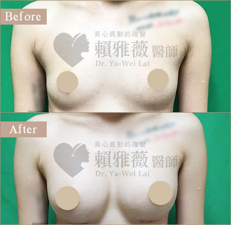 水滴形隆乳案例 水滴形隆乳案例