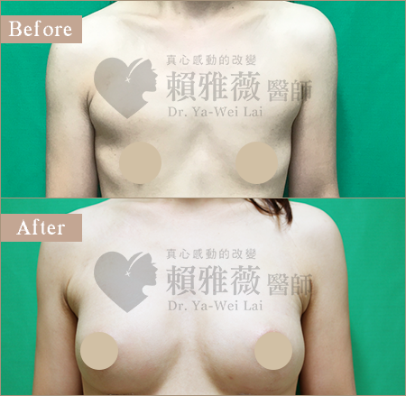 圓盤光滑面隆乳案例 圓盤光滑面隆乳案例