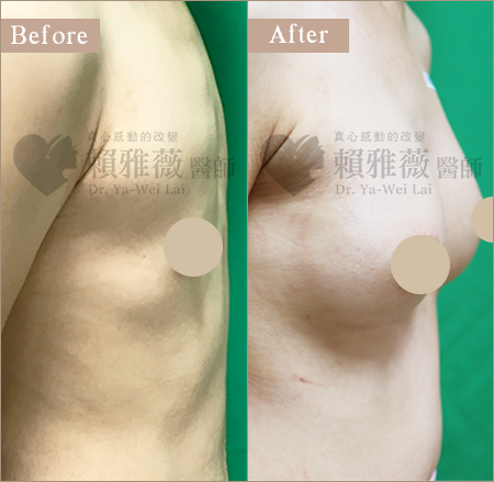 圓盤光滑面隆乳案例 圓盤光滑面隆乳案例