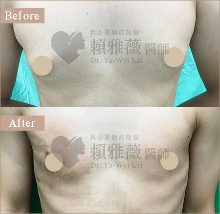水滴形隆乳案例 男性女乳症案例