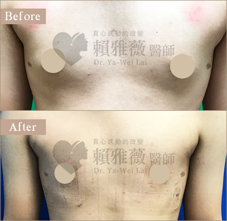 水滴形隆乳案例 男性女乳案例