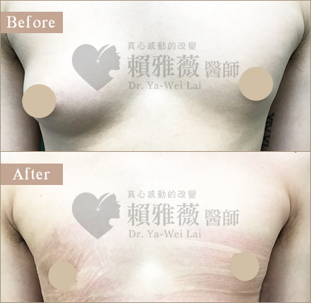 水滴形隆乳案例 男性女乳症案例