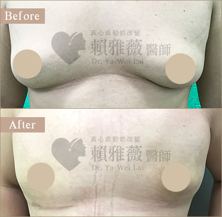 水滴形隆乳案例 男性女乳案例