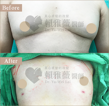 水滴形隆乳案例 男性女乳案例