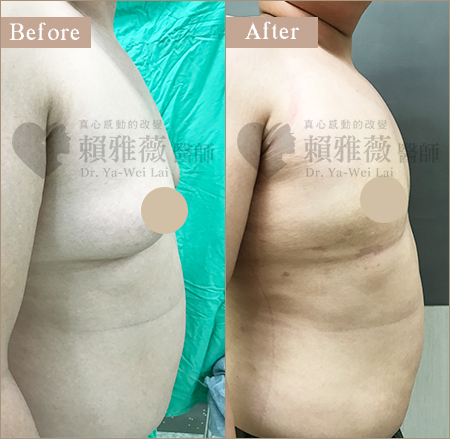 水滴形隆乳案例 男性女乳案例
