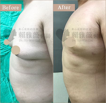 水滴形隆乳案例 男性女乳案例