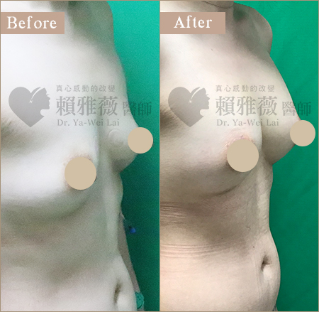 圓盤絨毛面隆乳案例 自體脂肪豐胸隆乳案例