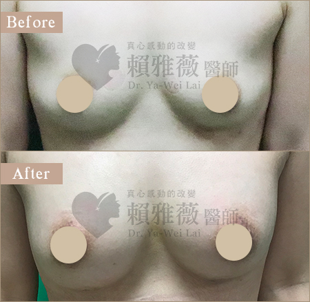 水滴形隆乳案例 自體脂肪隆乳案例