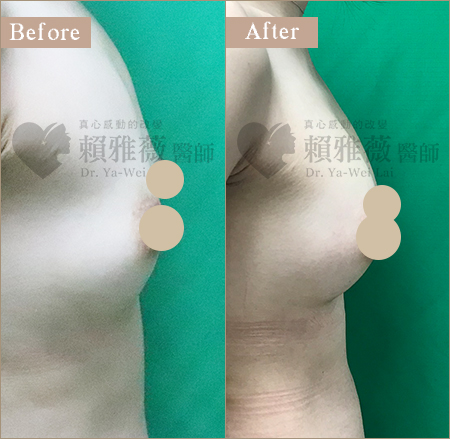 水滴形隆乳案例 自體脂肪豐胸案例