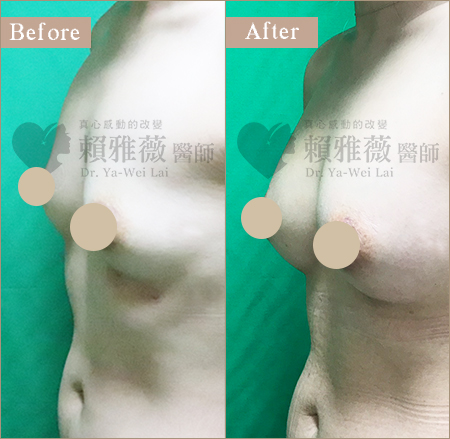 水滴形隆乳案例 自體脂肪隆乳案例