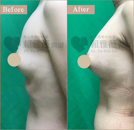 圓盤絨毛面隆乳案例 自體脂肪豐胸隆乳案例