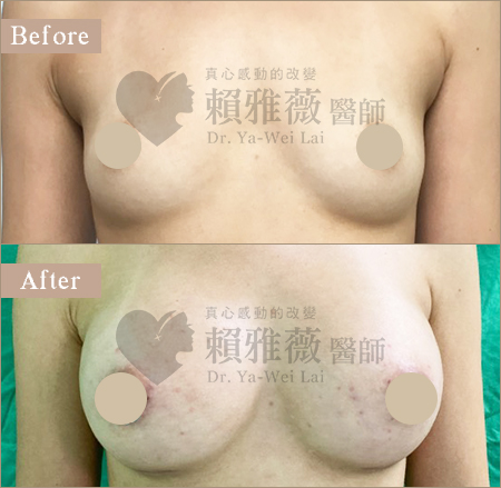 motiva魔滴隆乳案例
