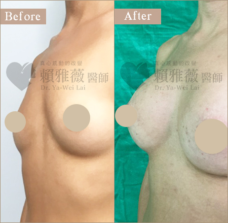 motiva魔滴隆乳案例