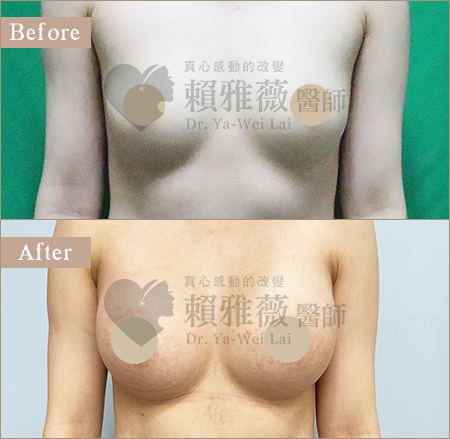 motiva魔滴隆乳案例