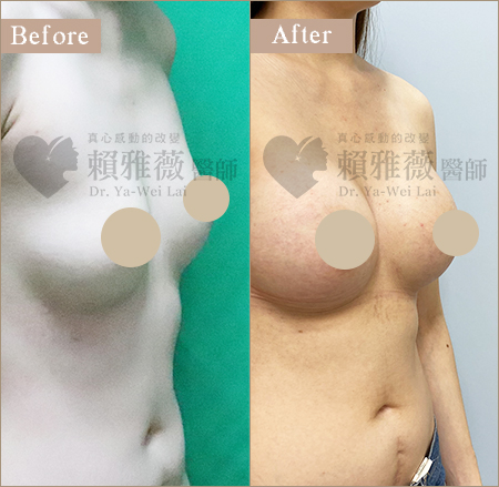 motiva魔滴隆乳案例