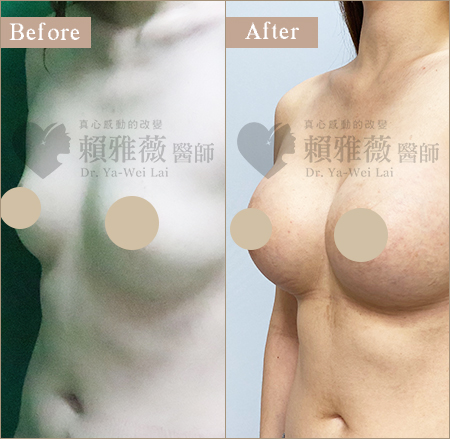 motiva魔滴隆乳案例