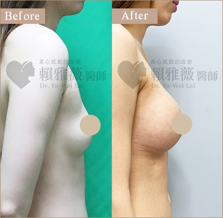 motiva魔滴隆乳案例