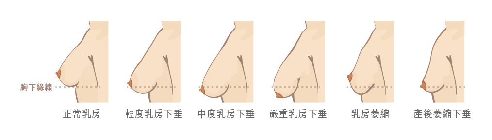乳房下垂分級表