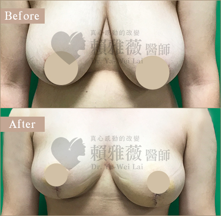 水滴形隆乳案例 縮胸手術案例