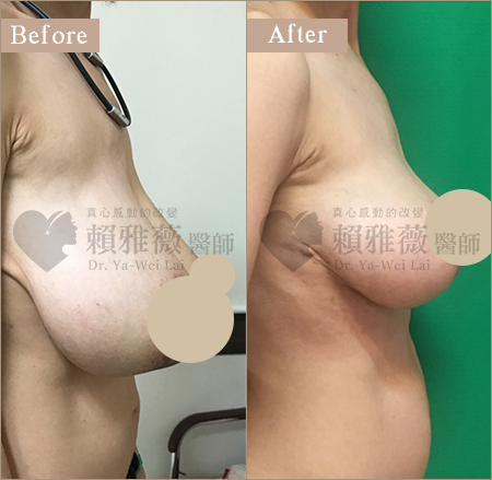 水滴形隆乳案例 縮胸手術案例