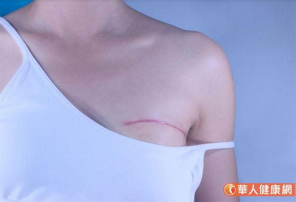 乳房整形手術後約7-14天傷口癒合後,建議就要開始塗抹疤痕凝膠 乳房整形手術後約7-14天傷口癒合後,建議就要開始塗抹疤痕凝膠